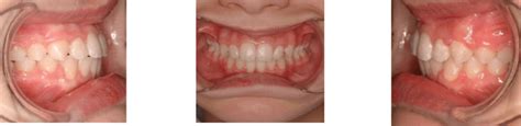 Class 2 Malocclusion Before And After Treatment