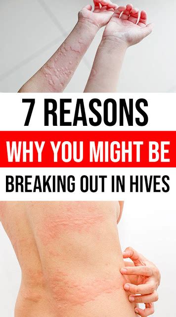 7 Reasons Why You Might Be Breaking Out In Hives Wellness Magazine