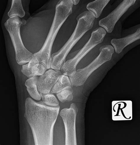 Triquetral Fracture Image Radiopaedia Org