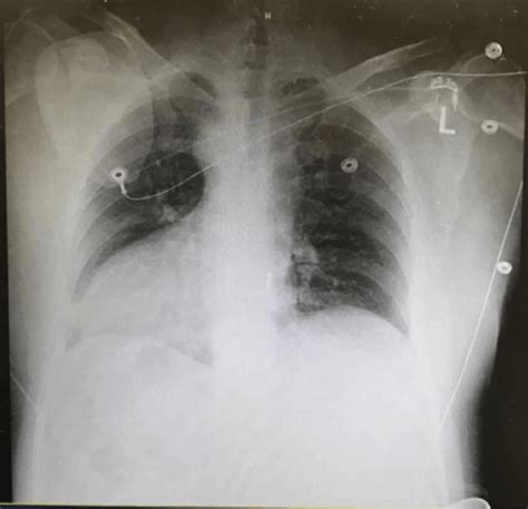 Dextrocardia: Can you pick it on ECG? | Resus