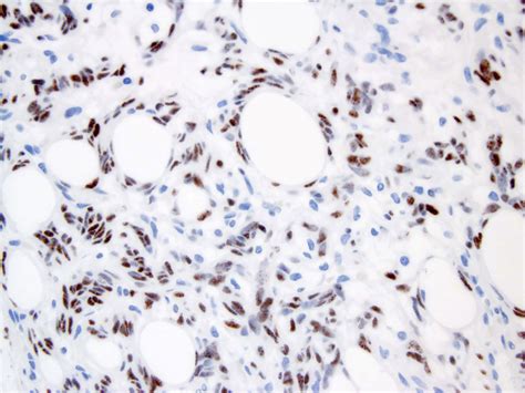 Pathology Outlines Solitary Fibrous Tumor