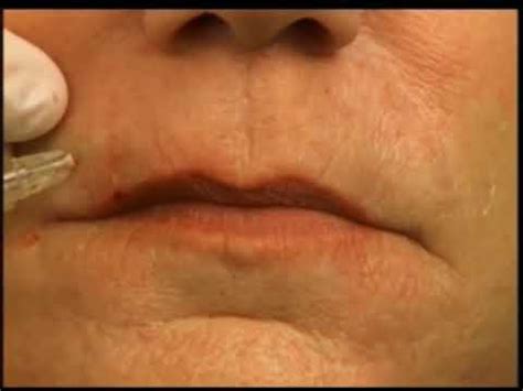 How To Fill Lip Lines Smokers Lines With Dermal Filler YouTube