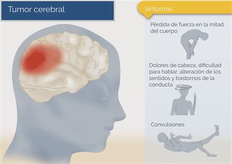 Tumor Cerebral Neurocirug A De La Torre