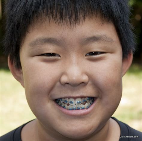 60 Photos of Teenagers with Braces | Oral Answers