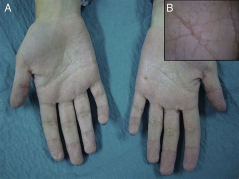 Aquagenic Keratoderma Associated With A Mutation Of The Cystic Fibrosis