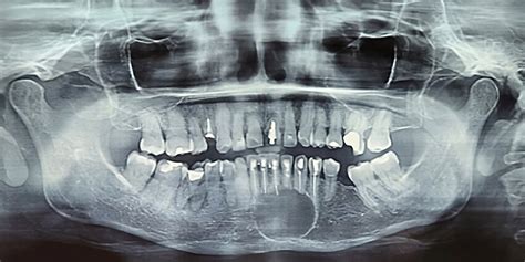 panoramic radiograph ten months post surgery showing progressive