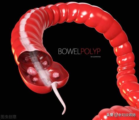 How Does The Body Feel When Polyps Grow In The Intestines Imedia