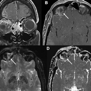 Mr Orbital Imaging In Patient A And B Demonstrate T Fat Suppressed