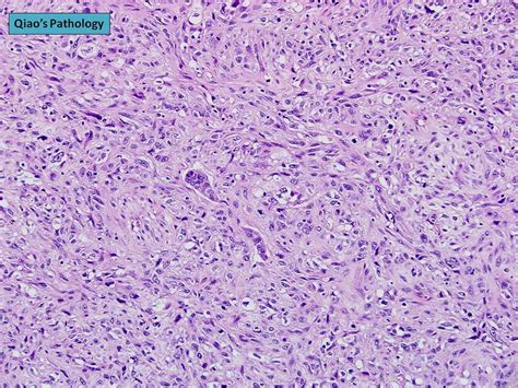 Qiao S Pathology Metaplastic Carcinoma Of The Breast A Photo On Flickriver