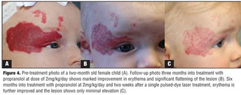 Beta Blockers An Innovation In The Treatment Of Infantile Hemangiomas