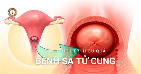 mach ban phuong phap day lui benh sa tu cung  phu nu