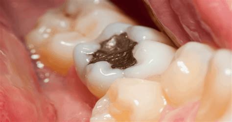 Safe Removal Of Mercury Based Amalgam Fillings