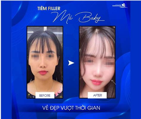 TiÊm Filler MÁ Baby VẺ ĐẸp VƯỢt ThỜi Gian