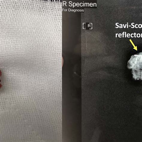 Biopsied Lesion And Specimen XR Containing Marking Clips And Savi Scout