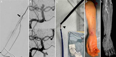 A Radial Artery Angiography Showing The Right Radial Artery Inner