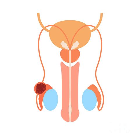 Testicular Cancer Photograph By Pikovit Science Photo Library Fine