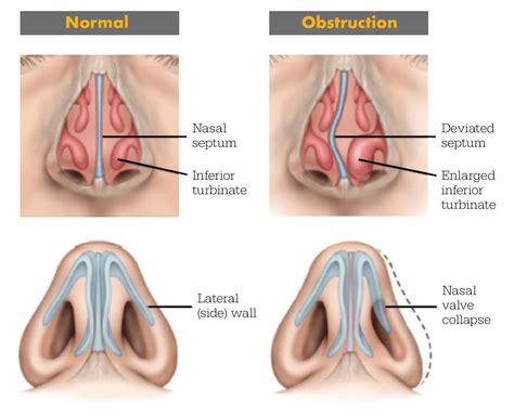 What Causes Swollen Nasal Passages