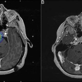 A Procedural Axial T1 Weighted Contrast Enhanced Brain MRI With