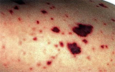 Bacterial Meningitis Rash