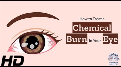 Eye Emergency How To Properly Manage A Chemical Burn In Your Eye Youtube