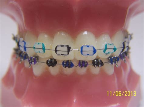 What Are The Best Color Combinations For Braces - Colorxml