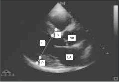 Linear Measurements Of Left Ventricular Septum Posterior Wall And Download Scientific Diagram