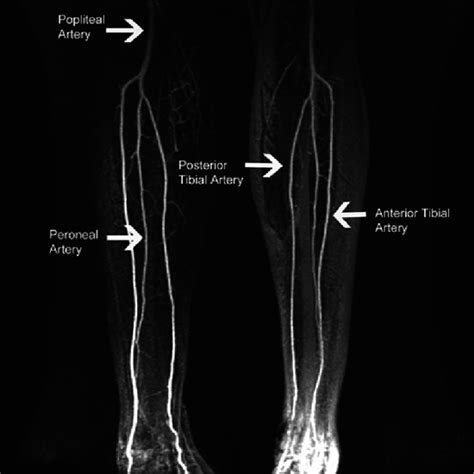 Mr Angiography Lower Limb Test Near You In Delhi Book Test At Low Price