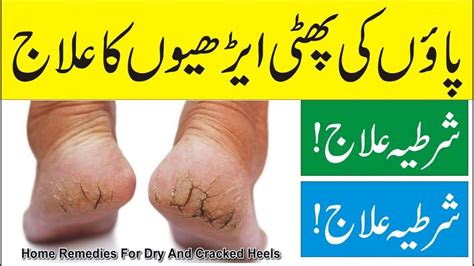 How To Solve Cracked Heels Problem Phati Arion Ka Ilaj Cracked