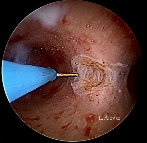 La cirugía histeroscópica de corrección del septo uterino reduce el