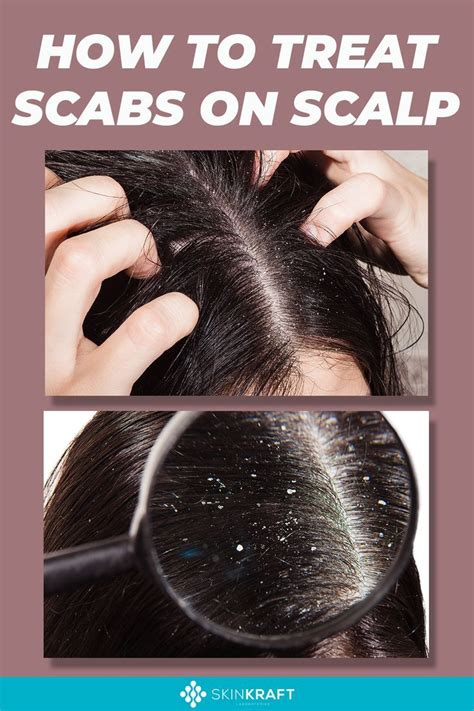 11 Causes of Scalp Scabs + How To Treat Them? | Scalp scabs, Infected ...