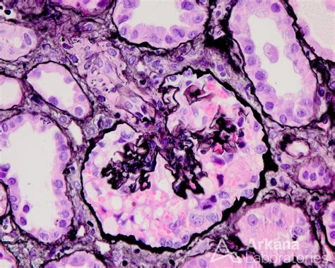 Collapsing Glomerulopathy Diagnose This Arkana Laboratories