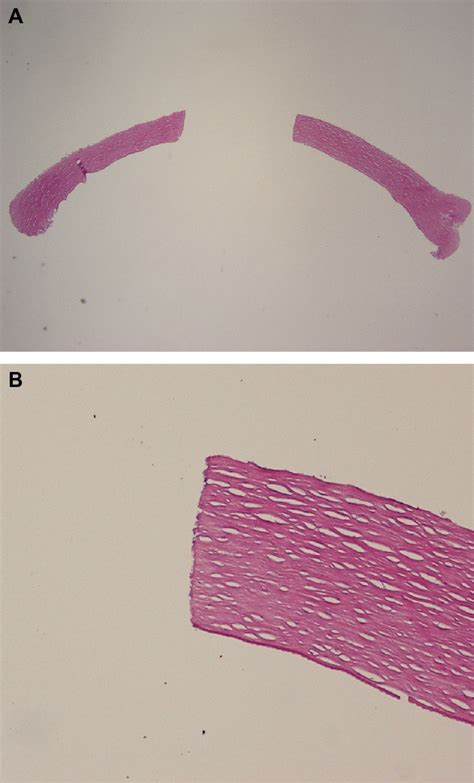 Figure 1 from Clinical Ophthalmology Dovepress Dovepress Femtosecond ...