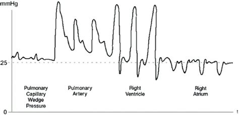 Right ventricular pressure tracings: pulmonary capillary wedge ...