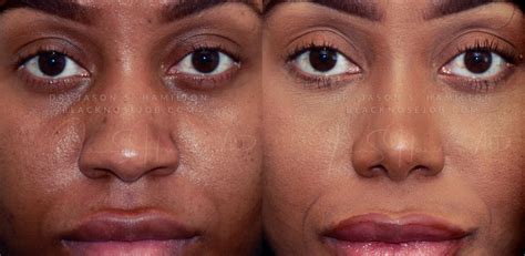 Black Rhinoplasty Before And After