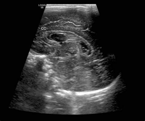 Grade Iv Germinal Matrix Hemorrhage With Periventricular Leukomalacia