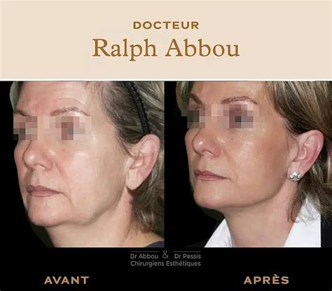 Avant Apres Lifting Du Visage Paris Dr Ralph Abbou