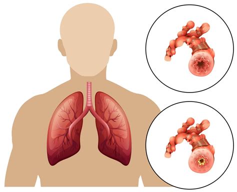 Human Chronic Obstructive Pulmonary Disease 303579 Vector Art At Vecteezy