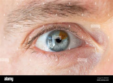 Macro Of A Man Eye With Heterochromia Extreme Close Up Of Human Eye Of Two Different Colors