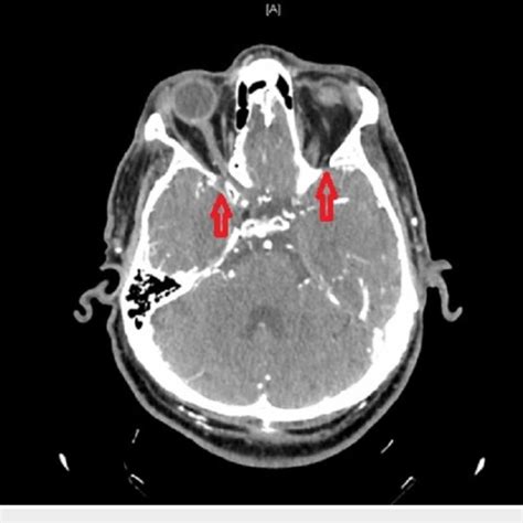 Neck and head CT angiography showed bilateral ICA occlusion ICA,... | Download Scientific Diagram