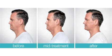 KYBELLA® for Men in Ann Arbor, Michigan | Center for Plastic Surgery ...