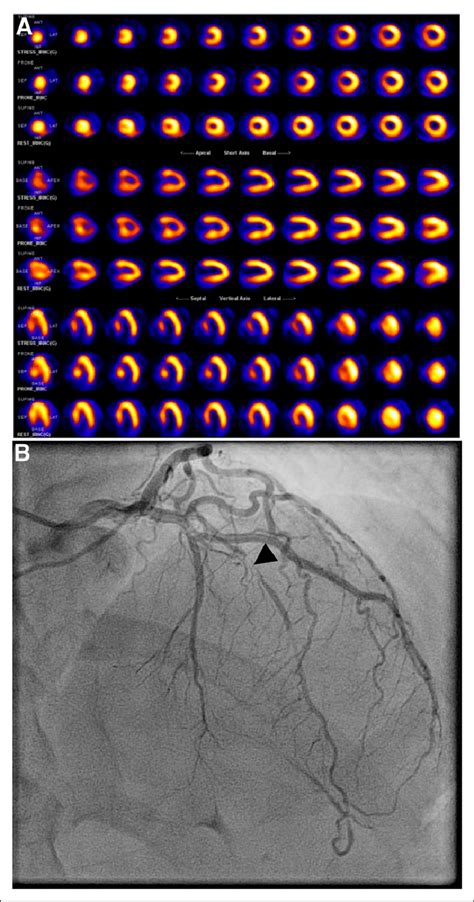 Myocardial Perfusion Images From Patient Patient In This Study