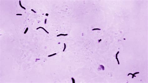 Kansas Is Dealing With Major Tuberculosis Outbreak - The New York Times