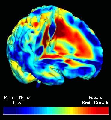 Schizophrenia Mri Public Neuroscience News