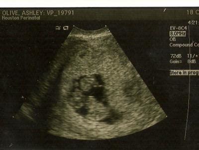 Identical Twins Ultrasound - Ashley Olive