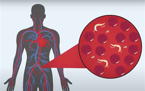 Schistosomiasis Bilharziasis Transmission Symptoms Diagnosis