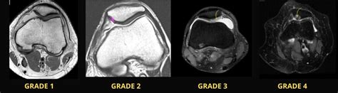 Knee Pain And Chondromalacia Patellae - Pro doctor