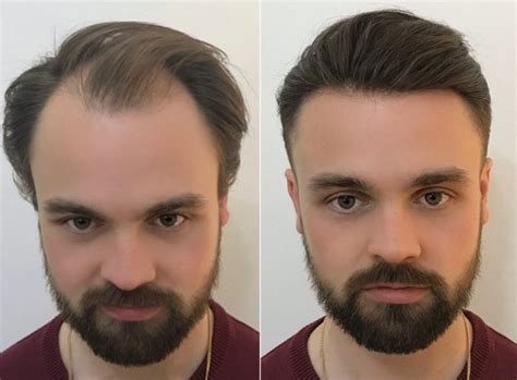 Hair Systems Melbourne Hair Replacement Systems For Men