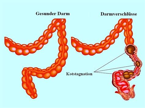 Symptome Bei Darmverschluss Ursachen Und Therapie