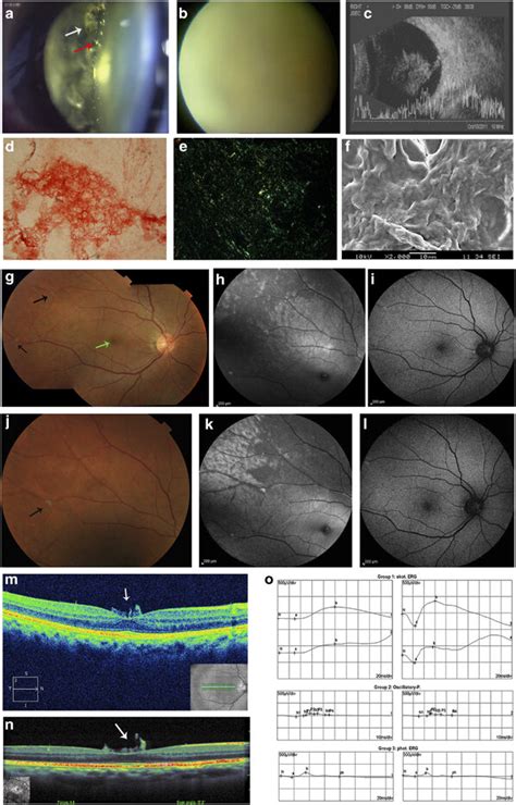 Clinical And Pathological Imaging Of The Probands Right Eye Ac