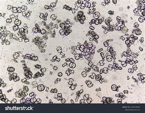 Microscopic Image Showing Calcium Oxalate Monohydrate Stock Photo